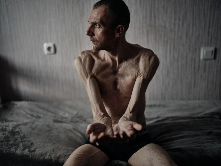 Photo report: Ukrainian POWs freed and lost weight