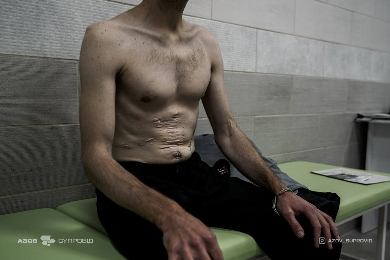 Released Azov fighters show effects of Russian captivity torture