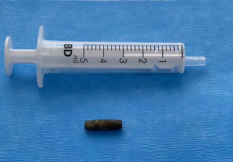Unique surgery: Bullet removed from soldier’s heart