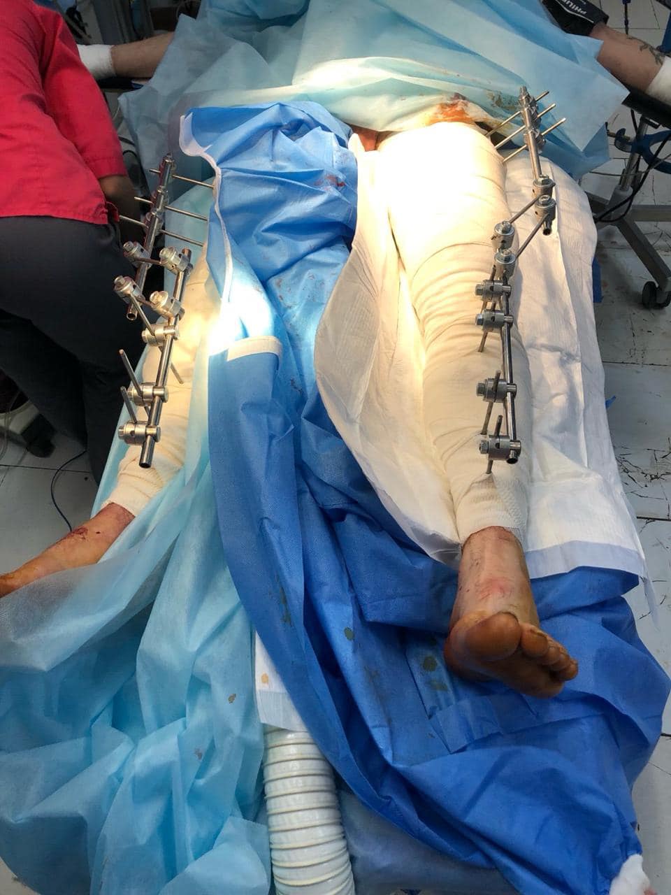 Volunteer Yusupova Raises Funds for 100 External Fixation Devices for Hospital