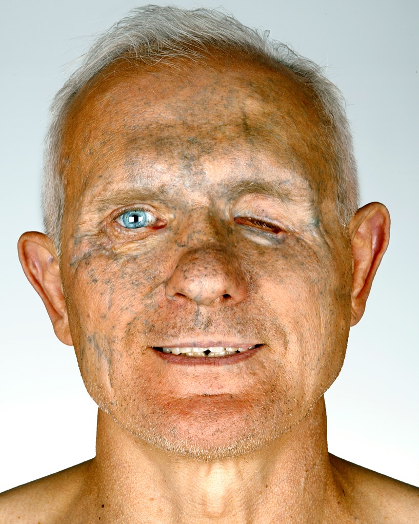 Bakhmut vet, facial reconstruction, returns to climbing, aims for inclusive veteran team