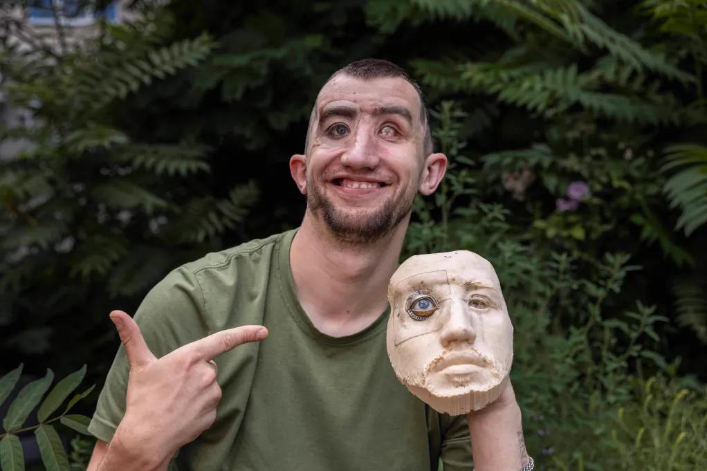 Ukrainian soldier loses sight, face rebuilt with titanium after Russian missile strike