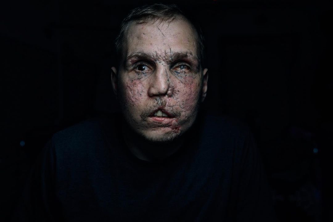 Ukrainian defender Serhii loses legs and vision, family believes he will recover